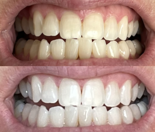 teeth before after with lifesmile whitener
